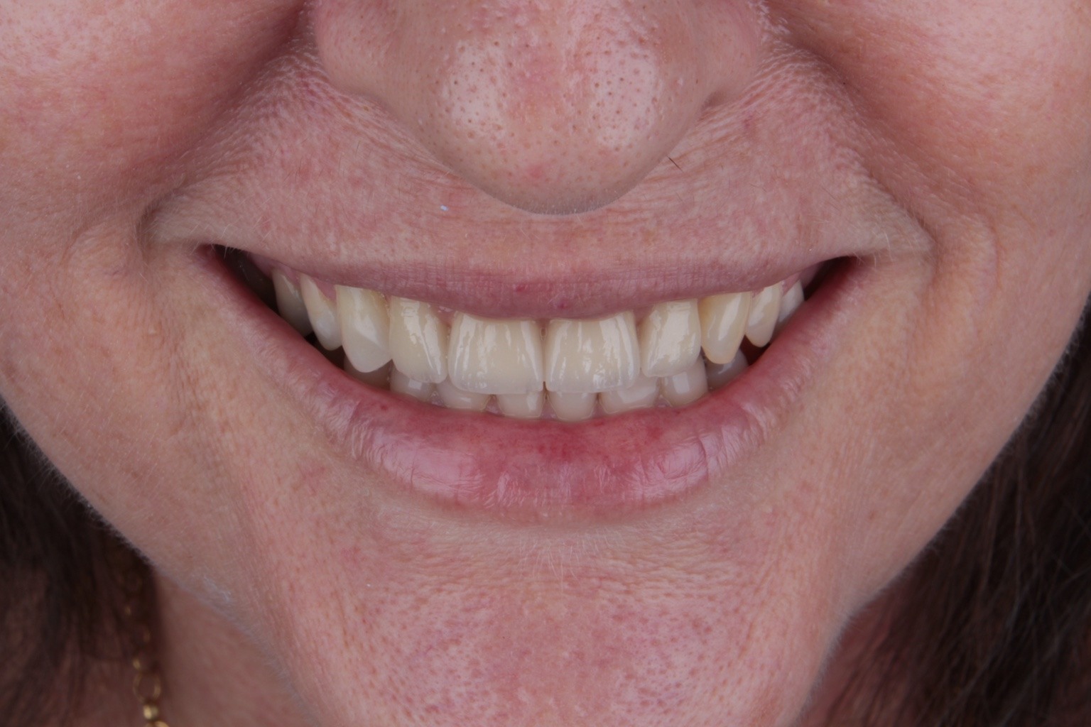 Detalhe clínico do sorriso
