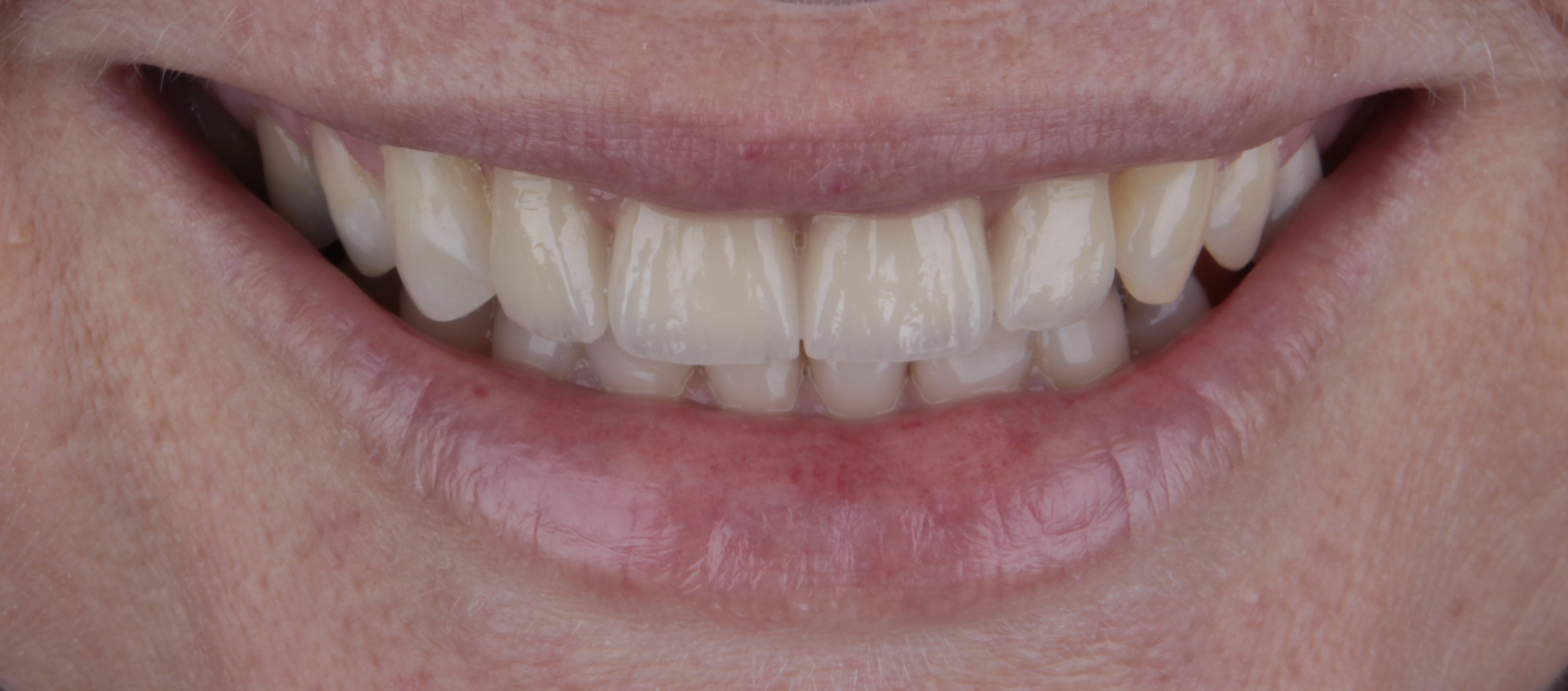 Close clínico dos dentes